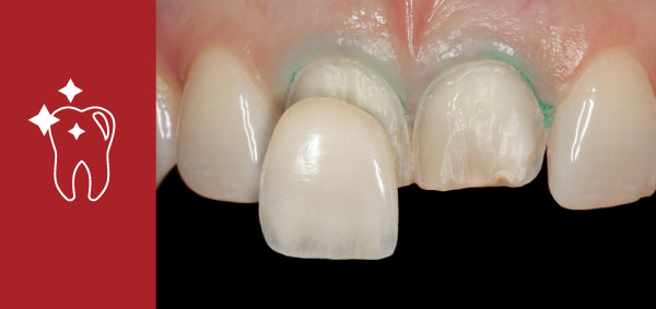 Restorative Dentistry in Dedham