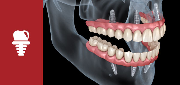 Dental Implants in Dedham