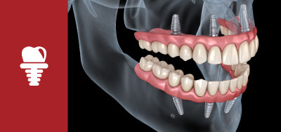 Dental Implants