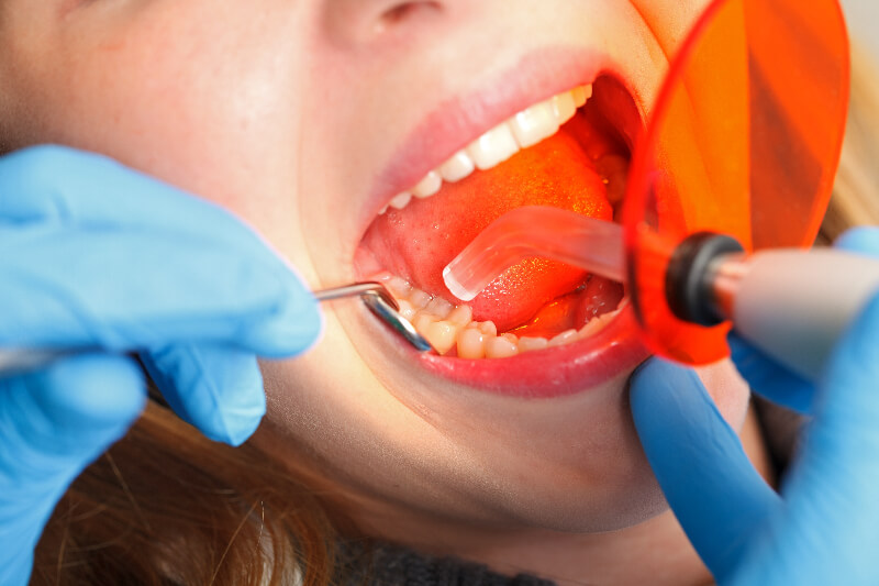 Dental bonding procedure