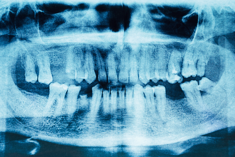 Dental x-ray with missing teeth