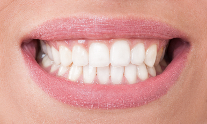 Results of full mouth rehab