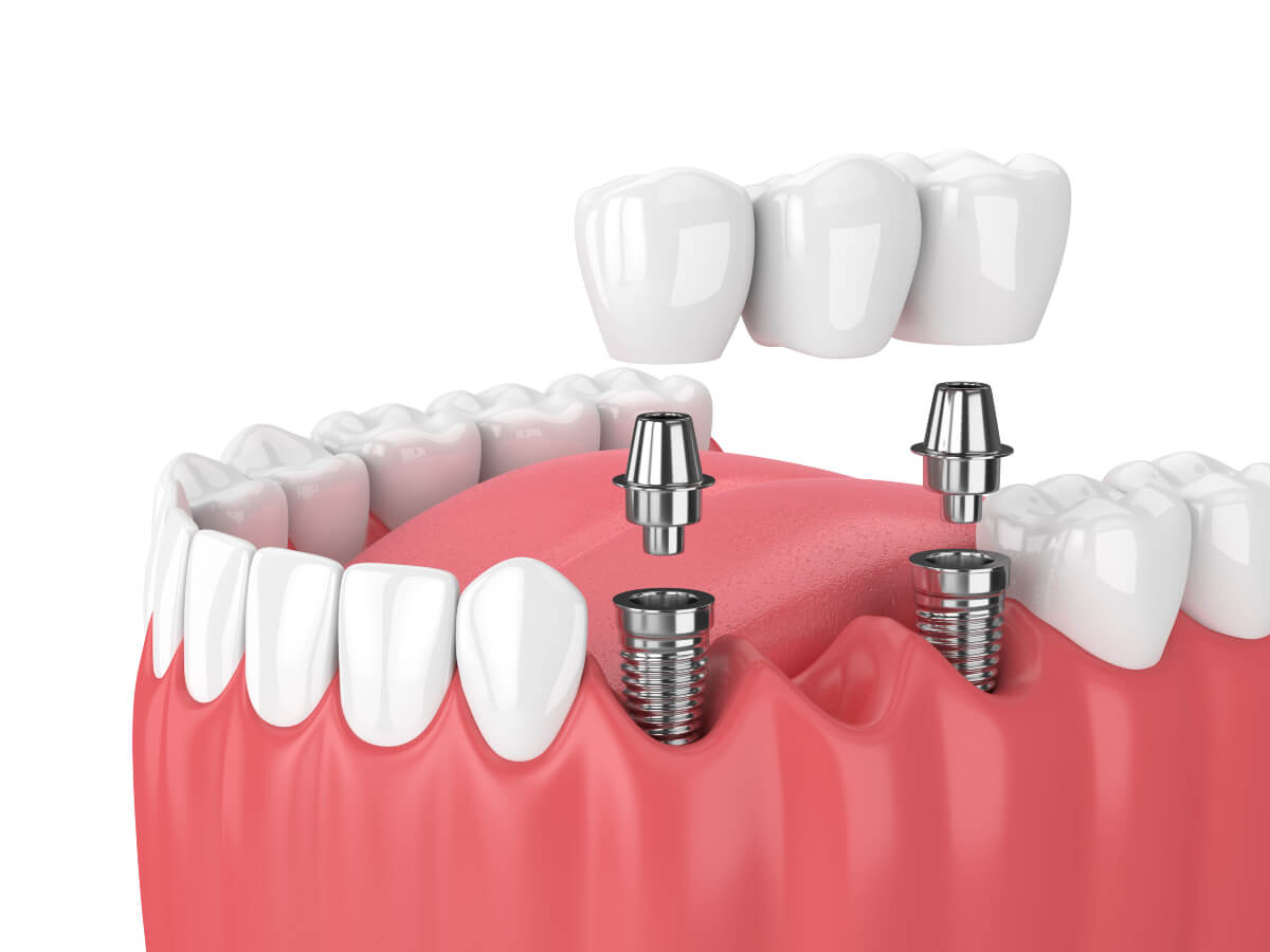 Dedham full mouth rehab