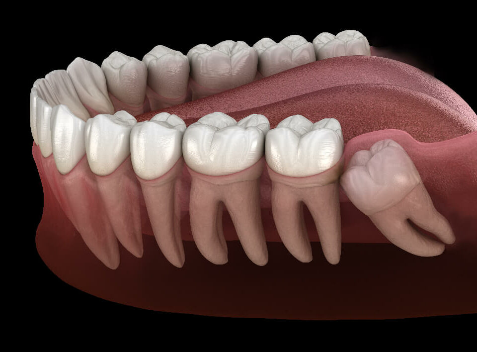 Wisdom tooth removal