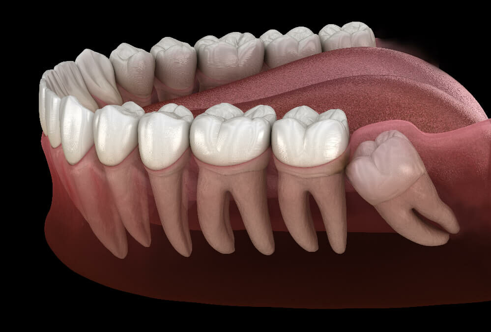 Wisdom tooth removal