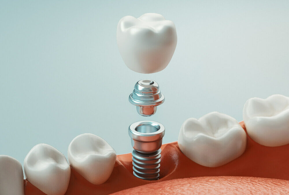 Dental implants