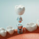 Dental implants