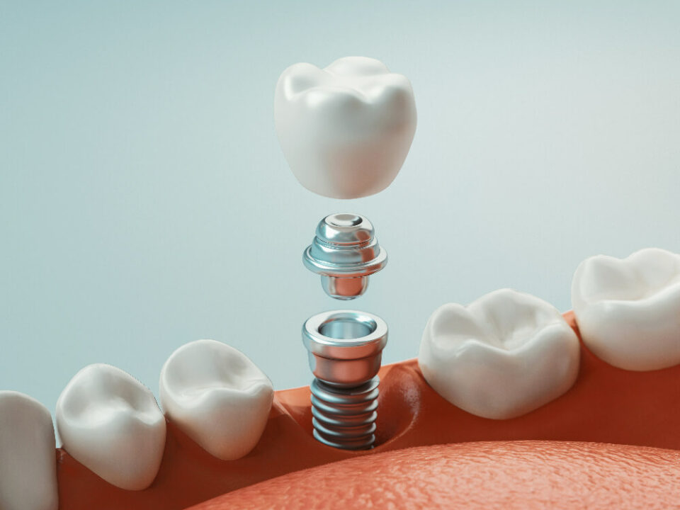 Dental implants