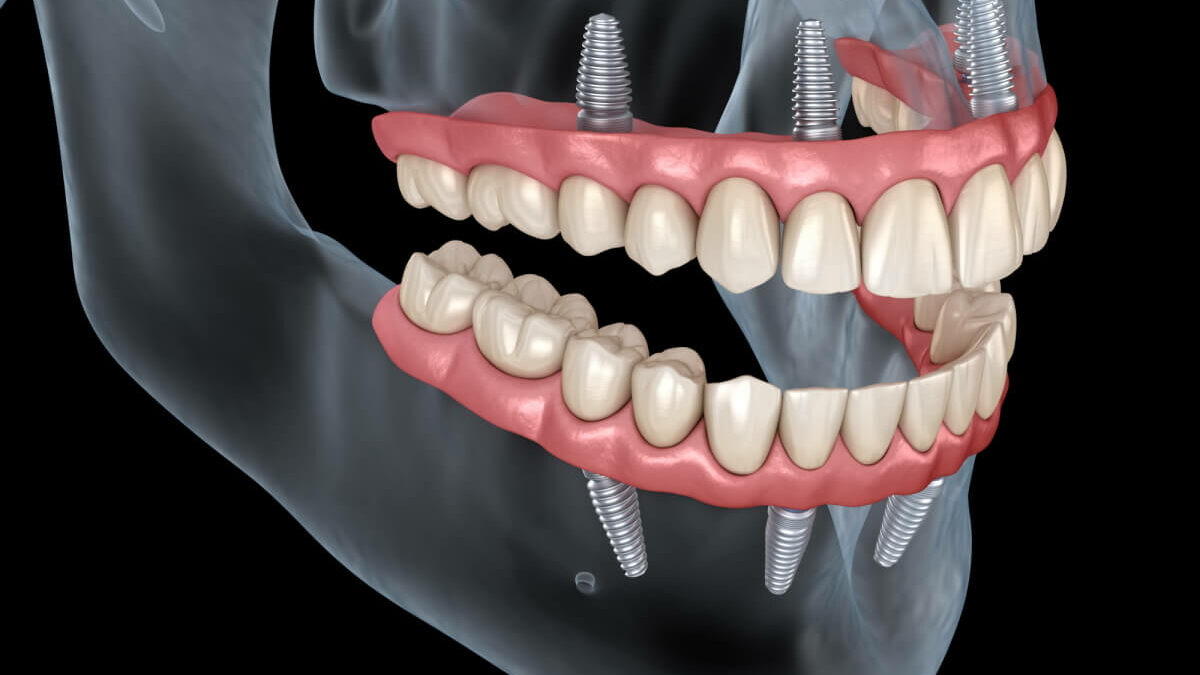 Dental implants Kent