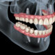 What can you eat with dental implantes and what should you avoid to eat