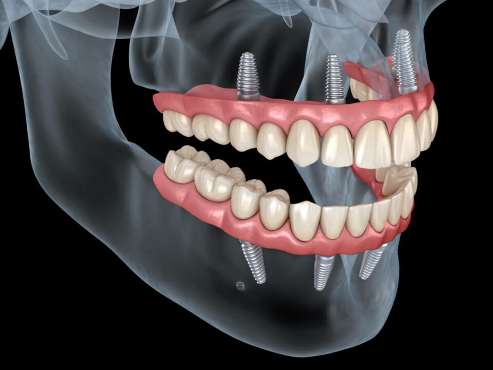 What can you eat with dental implantes and what should you avoid to eat