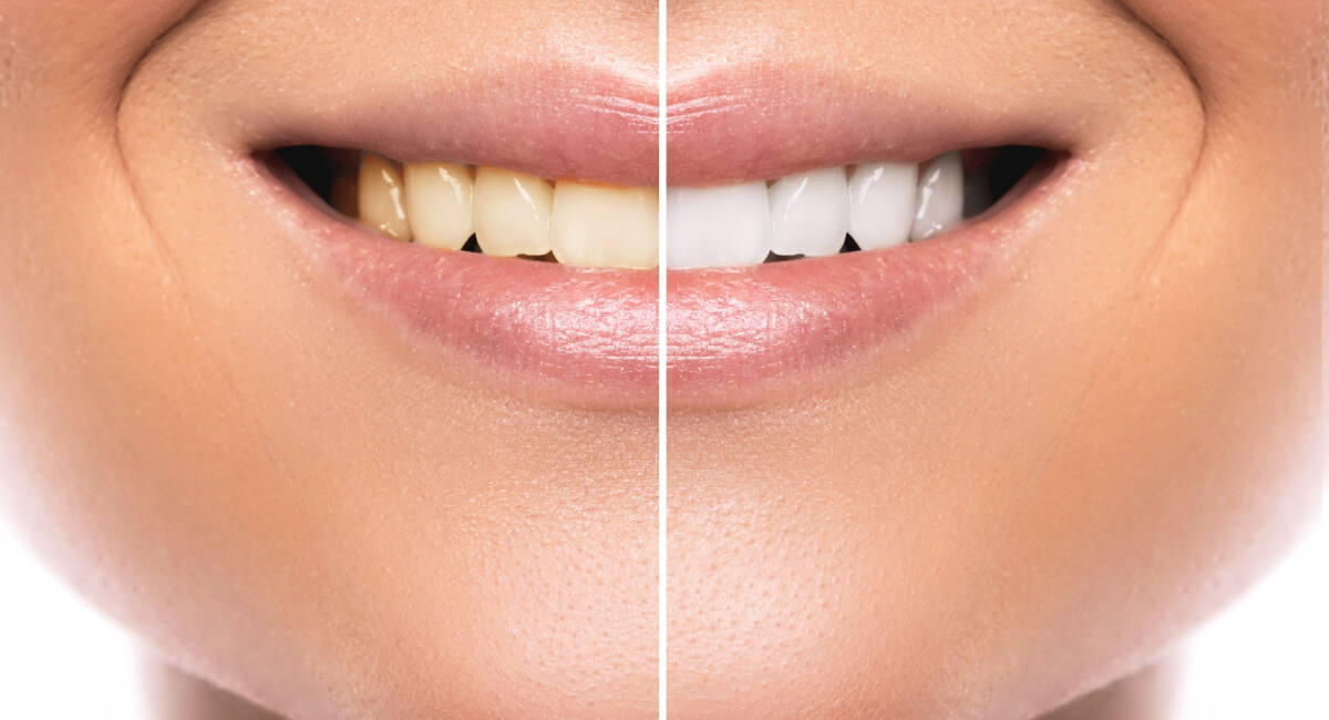 Teeth before and after our teeth whitening treatment.