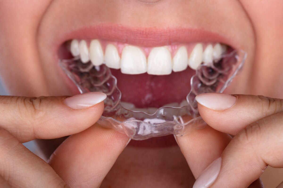 aligners tooth movement