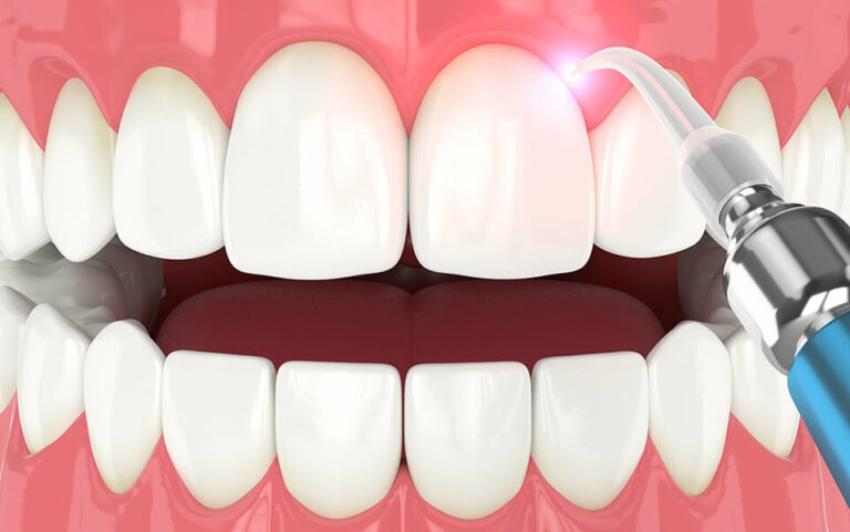 What Is An Alveoloplasty? | Digital Dental Studio
